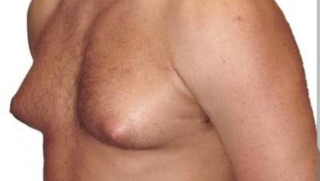 Picture illustration of Men with Enlarge breast
